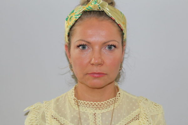 botox before