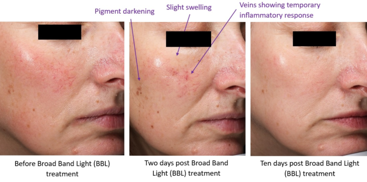 Laser Treatment Side Effects In Tamil Sciton BBL Broad Band Light Laser Side Effects | Woodford Medical