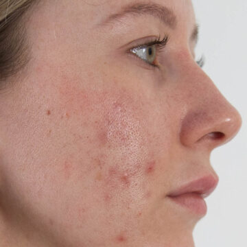 June is Acne Awareness month - read how to combat this distressing condition