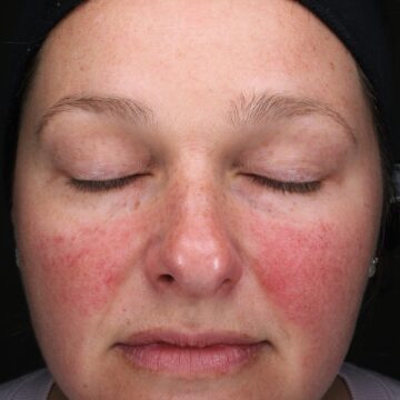 Rosacea Awareness Month