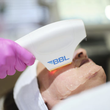 Sciton BBL Broad Band Light Laser Side Effects