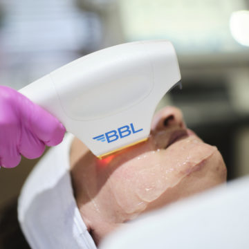 IPL using BBL/Moxi Laser Technology