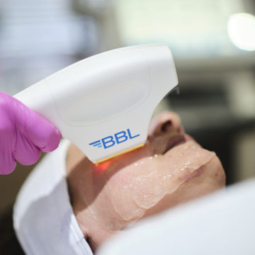 BBL Laser Treatment Unveiled