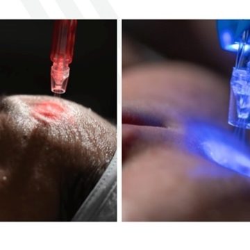 Jet Peel at Woodford Medical