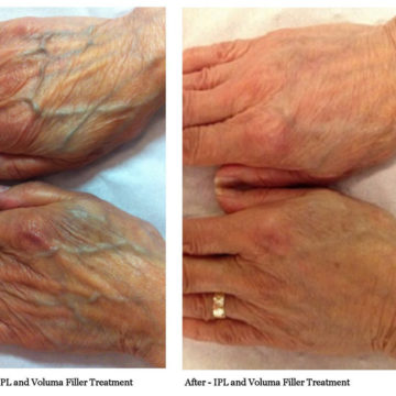 Turning Back The Hands Of Time With Juvederm Voluma