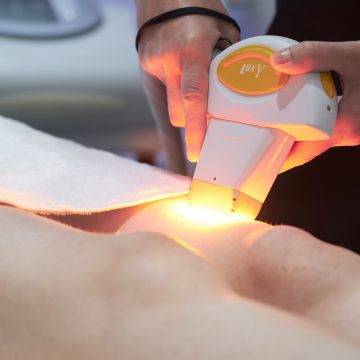 Laser/IPL Hair Removal