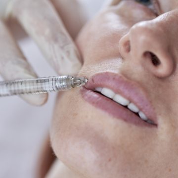Juvéderm Volbella Lip Fillers