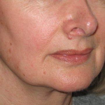 Our Guide To Treating Unwanted Pigmentation