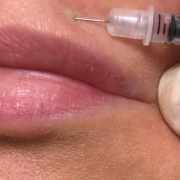 The Botox lip flip - an off label use for this versatile product