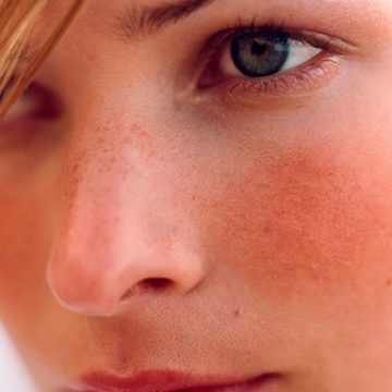 Three ways to deal with Rosacea
