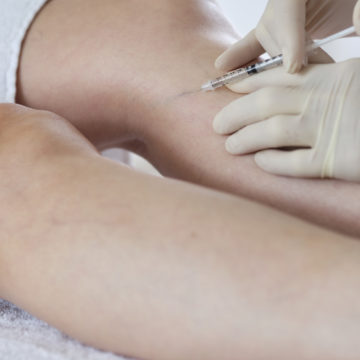 Sclerotherapy For Leg Veins