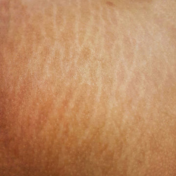 Poor Skin Quality, Scars And Stretchmarks