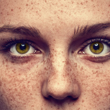 Sun Damage and pigmentation