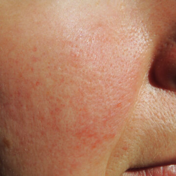 Facial Redness, Rosacea And Blushing