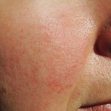 April is Rosacea Awareness Month