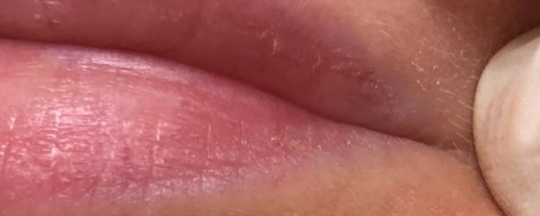 The Botox lip flip - an off label use for this versatile product