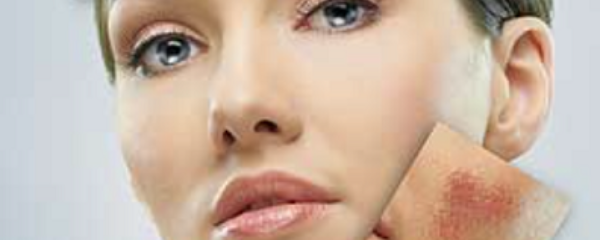 The sensitive skin epidemic