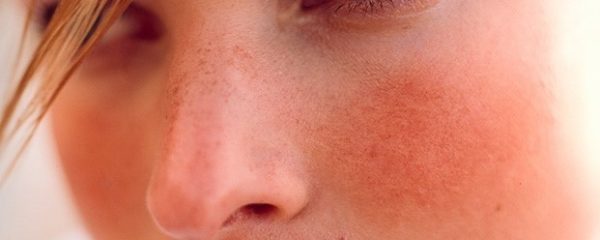 Three ways to deal with Rosacea