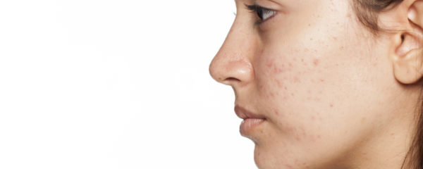 Acne Awareness