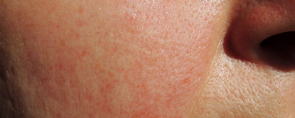 April is Rosacea Awareness Month