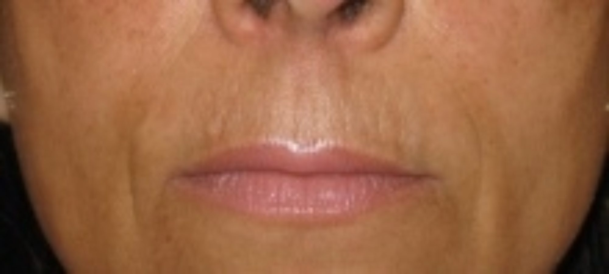 Dermafrac treatment combining microneedling with infusion | Woodford ...