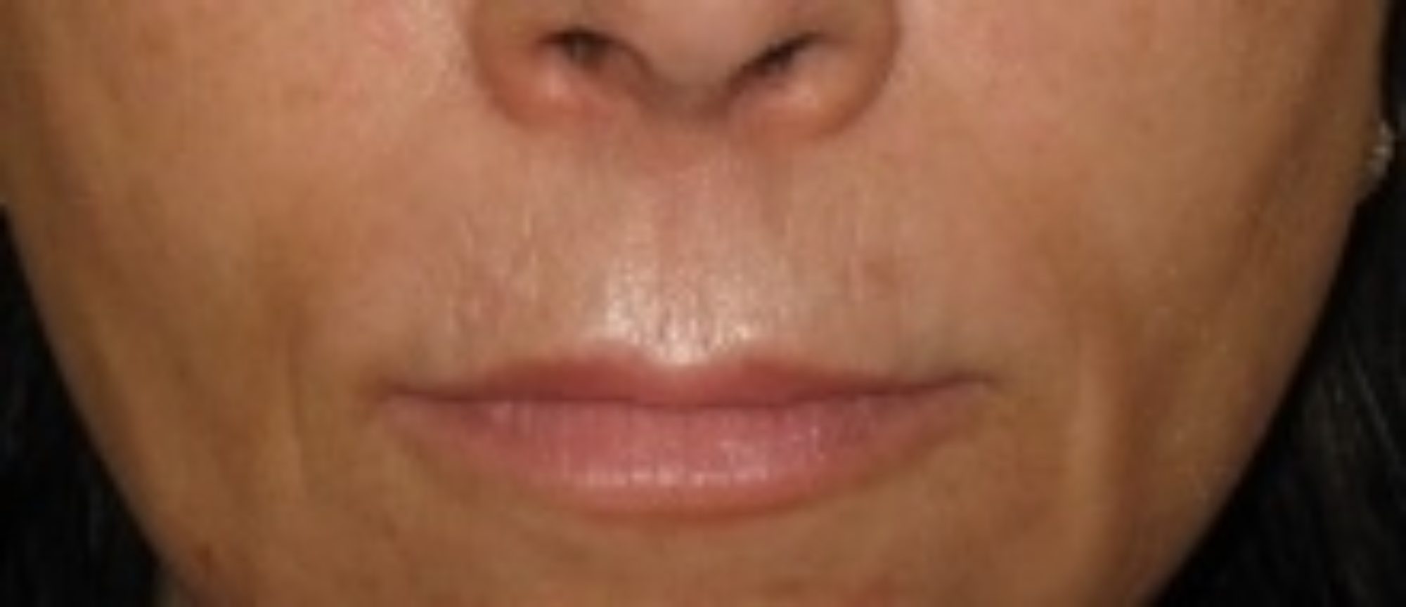 Dermafrac treatment combining microneedling with infusion | Woodford ...